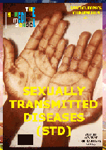 Sexually Transmitted Diseases